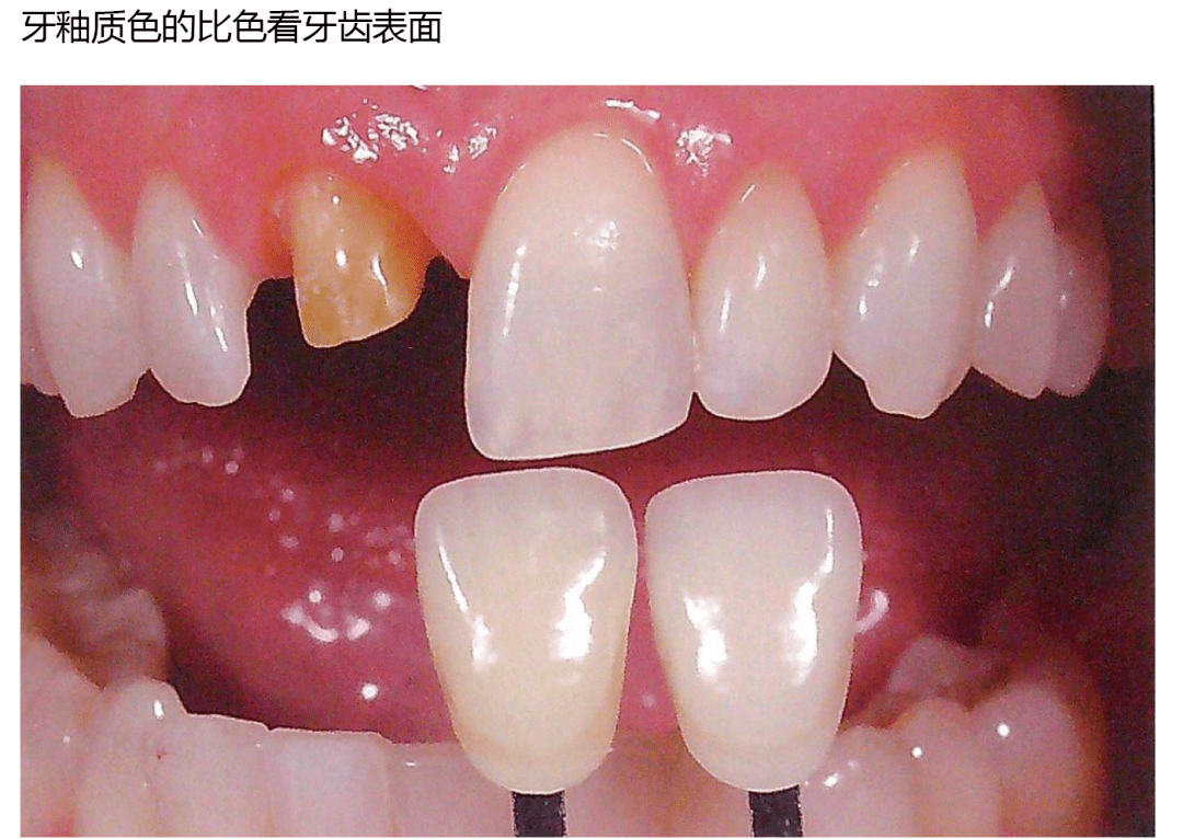 牙釉质的颜色图片