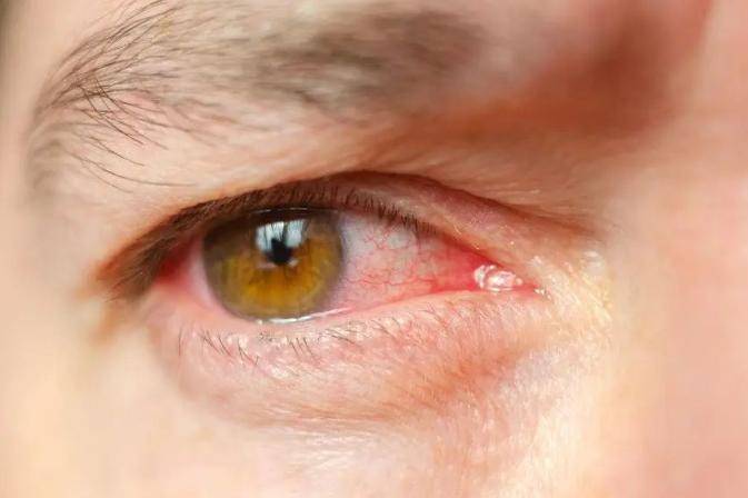 血糖高的人，眼睛胀痛、视力模糊？或有失明可能，4个办法远离_病变_检查_视网膜