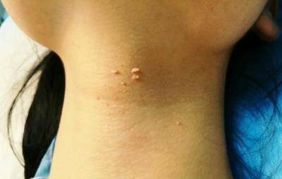 脖子和腋下的"小肉球"到底是啥玩意儿?用手抠掉行不行?