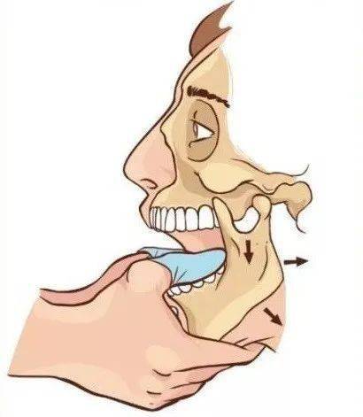 【健康科普 | 医生说】颞下颌关节脱位的治疗_患者_术者_临床