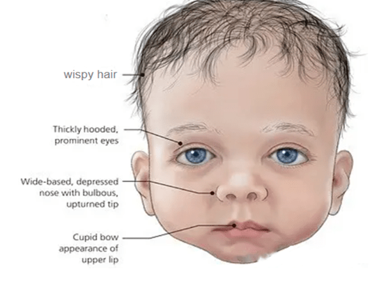 努南综合征_患者_面容_条件