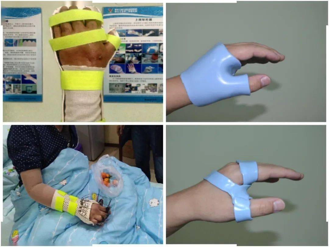 省第二医院康复医学科为您讲解手外伤康复相关知识_活动_损伤_功能