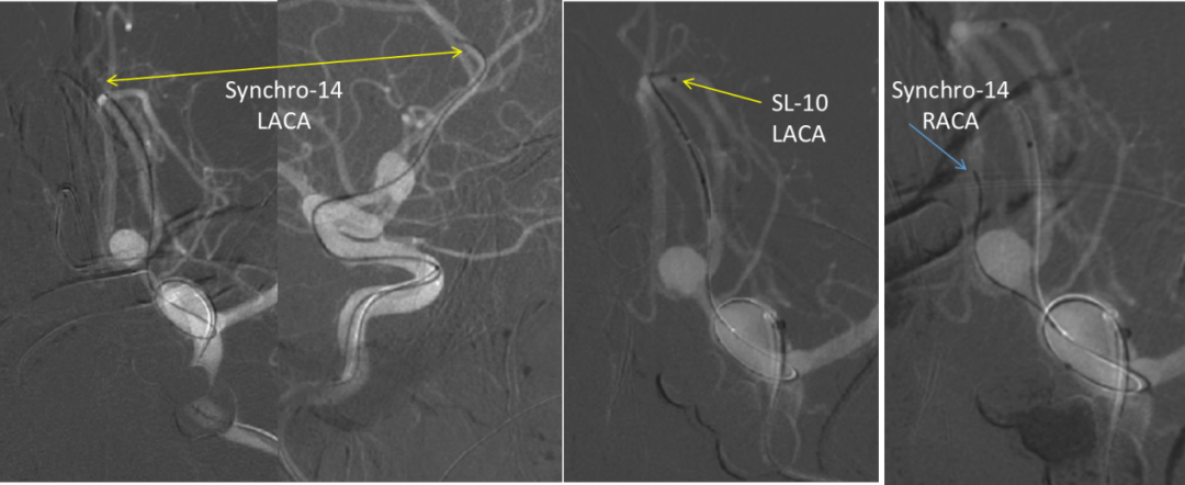 随后synchro 14微导丝经左侧大脑前动脉a1段及前交通动脉送入同侧大脑
