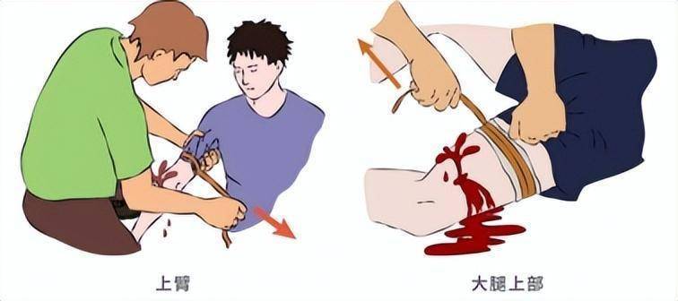 橡皮止血带的绑法图片