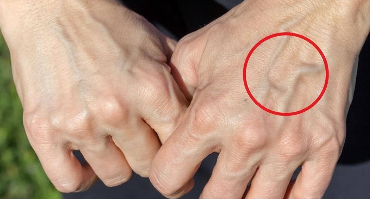 为何有些人手臂"青筋暴起",有人却看不到"青筋",看完就懂了_血管_身体