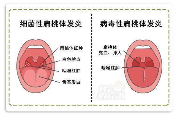 扁桃体发炎会传染吗图片