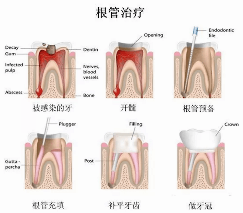 如果根管治疗后坚决不戴牙冠,会怎么样?_牙齿_进行_牙髓炎