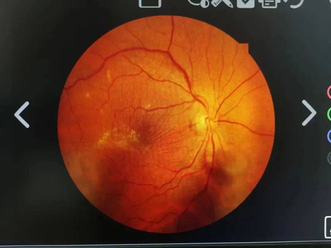 【每周睛彩图集】玻璃体牵拉引起黄斑裂孔，这张OCT拍到了关键证据……_视网膜
