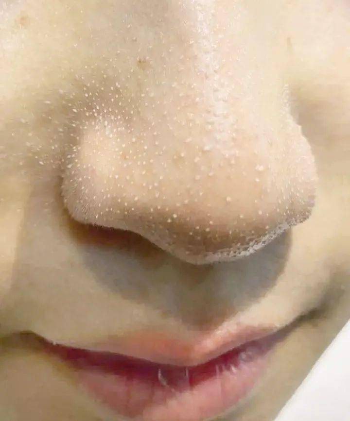 用这招"灭"黑头才是王道!_毛孔_鼻子_油脂