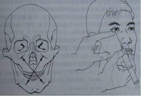 進針點:眶下孔內下方1cm,鼻翼外側約1cm 處.
