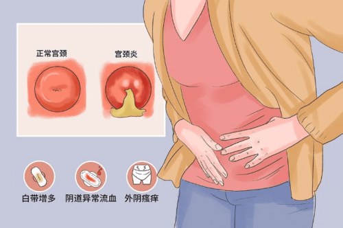 宫颈炎分泌物症状图片图片