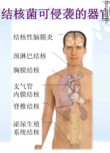 认识结核病_手机搜狐网