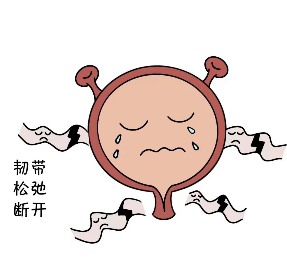 哭泣膀胱的自白——压力性尿失禁_尿液_治疗_主人公