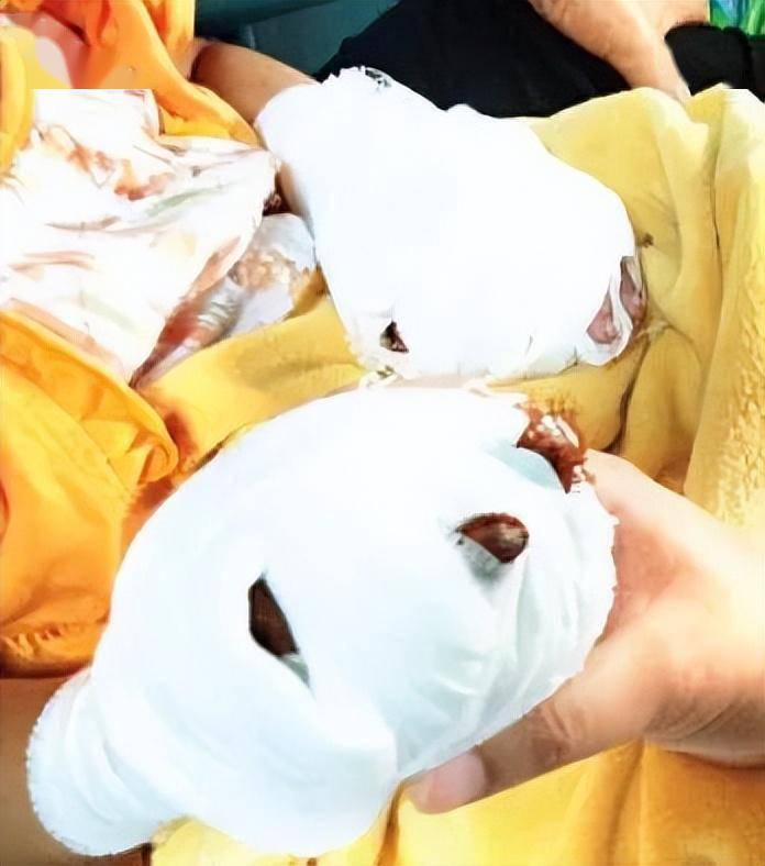 将金属筷插入插座中,导致双手触电深度烧伤,右手食指后期进行截肢手术