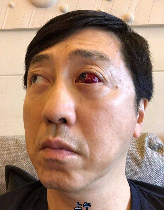 庾澄庆左眼被鲜血染红,自嘲是孙悟空的火眼金睛_结膜_患者_医生