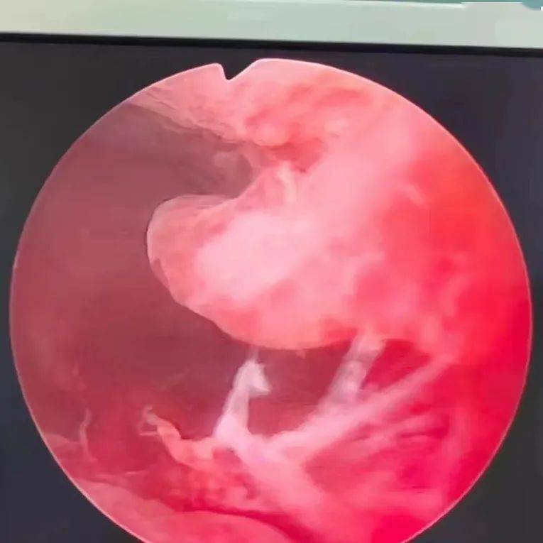 子宫内膜息肉流血图片图片