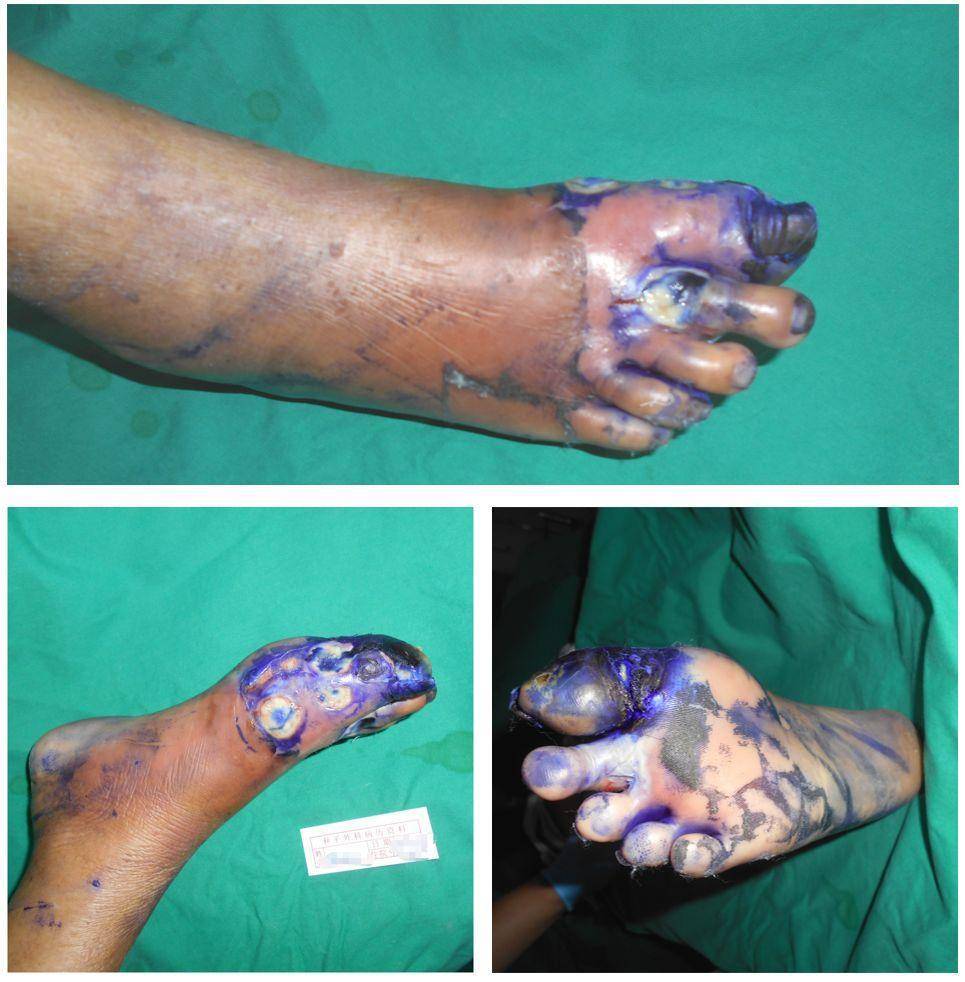 糖尿病足治疗实例:4级糖尿病足竟然不用截肢!医生是怎么做的?