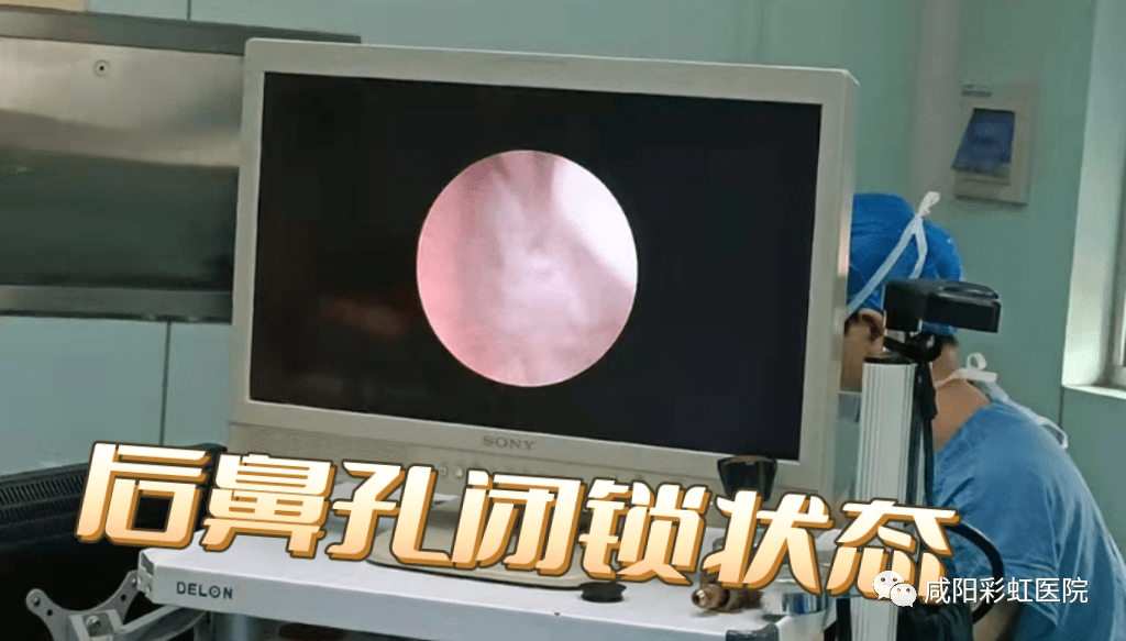 "先天性后鼻孔闭锁"患儿重获新生_彩虹医院_费国立_进行了
