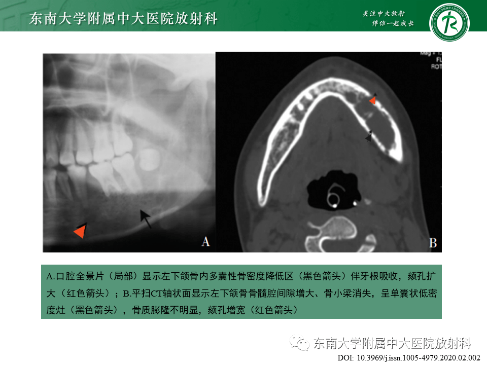 頜骨動靜脈畸形影像診斷_全網_解剖圖_後牙