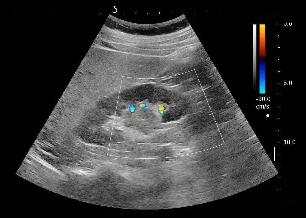 痛风肾超声表现图片