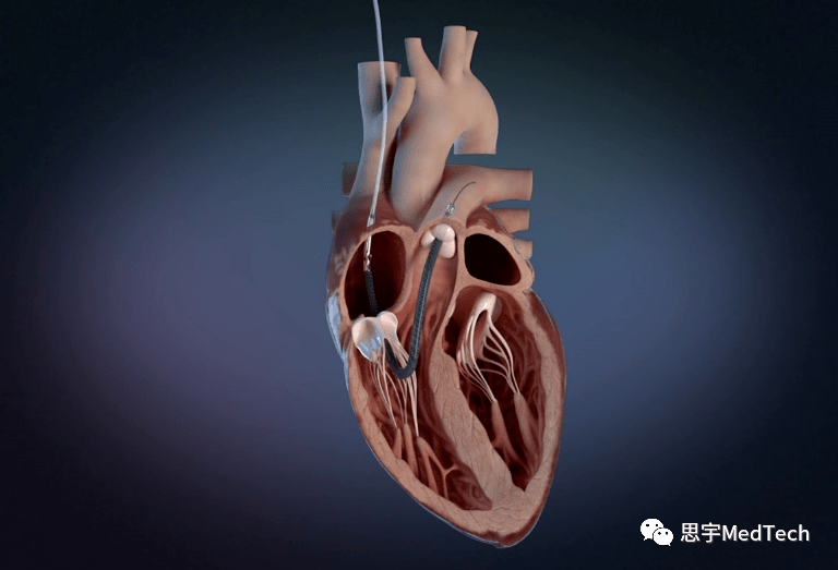 被强生收购的人工心脏新增适应症_impella_abiomed_患者