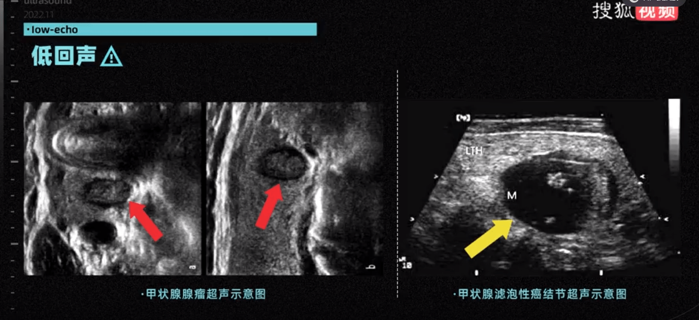 超声_图像_反射