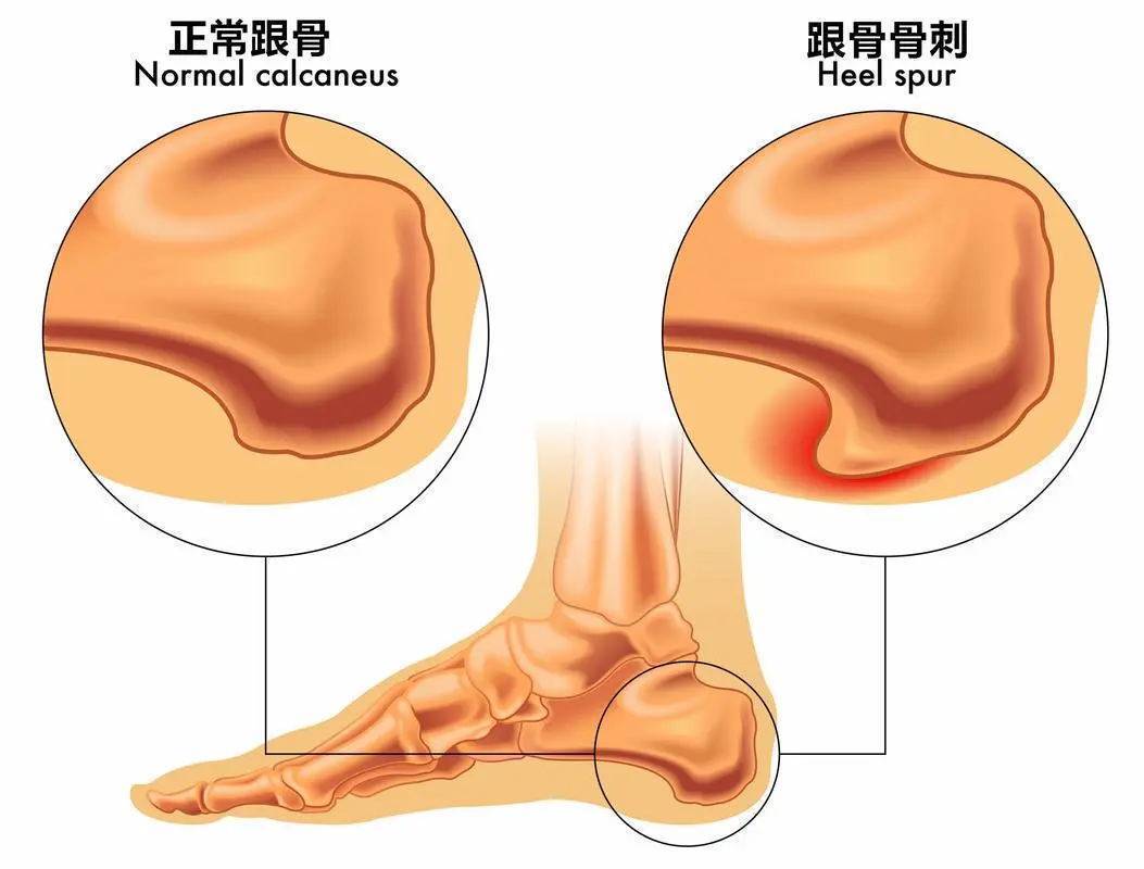 跖腱膜炎怎么治疗图片