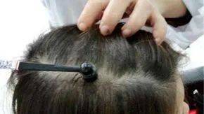 梅花针是如何治疗脱发的?_头皮_局部_毛囊