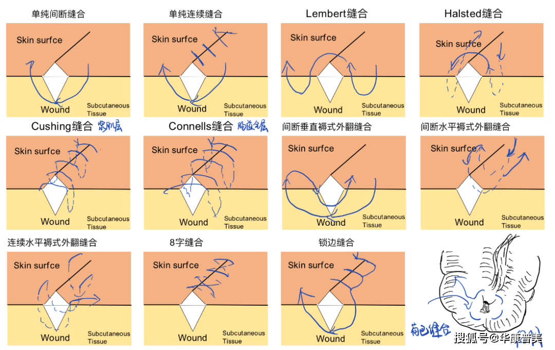 间断缝合法图解图片