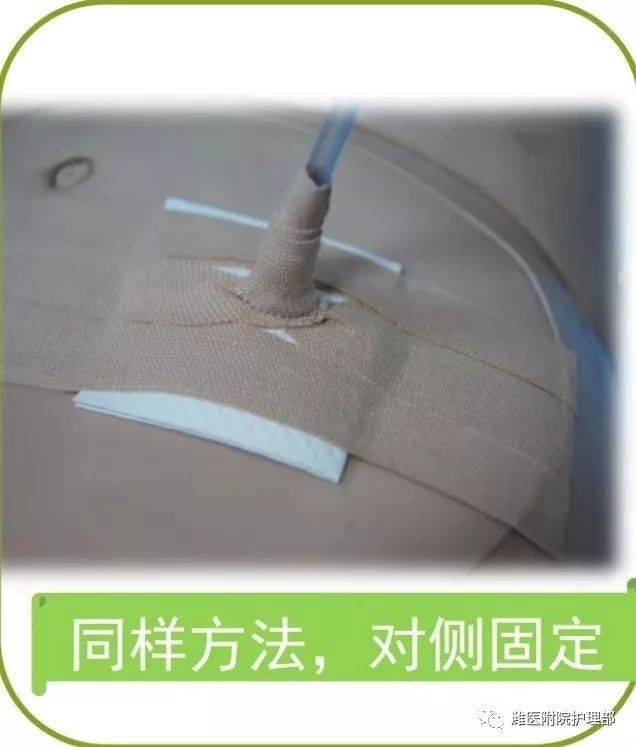 这里有八种引流管固定方法,固定的结实又漂亮!_胶带_护理_管路