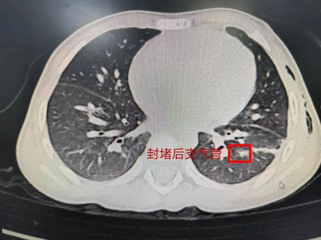 支氣管胸膜瘻( bpf)是指各級支氣管與胸膜腔交通形成的異常竇道的統稱