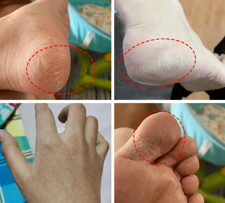 脚痒有水泡可以用身体乳吗(脚痒有水泡可以用身体乳吗图片)