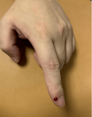 少商穴定位:手大指指末节桡侧,距手指甲角0.