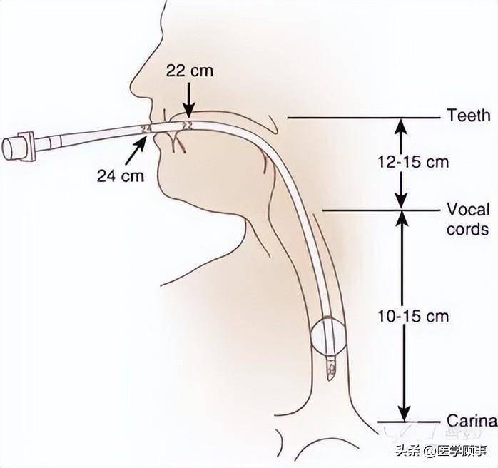 双腔气管导管插管技巧图片