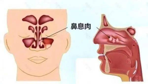 鼻息肉严重吗图片