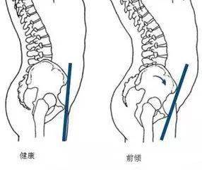 骨盆前傾:體態上表現