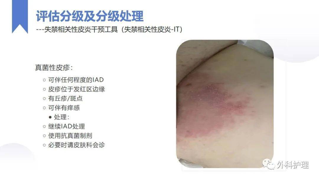 【ppt】失禁性皮炎的护理_皮肤_工作_相关