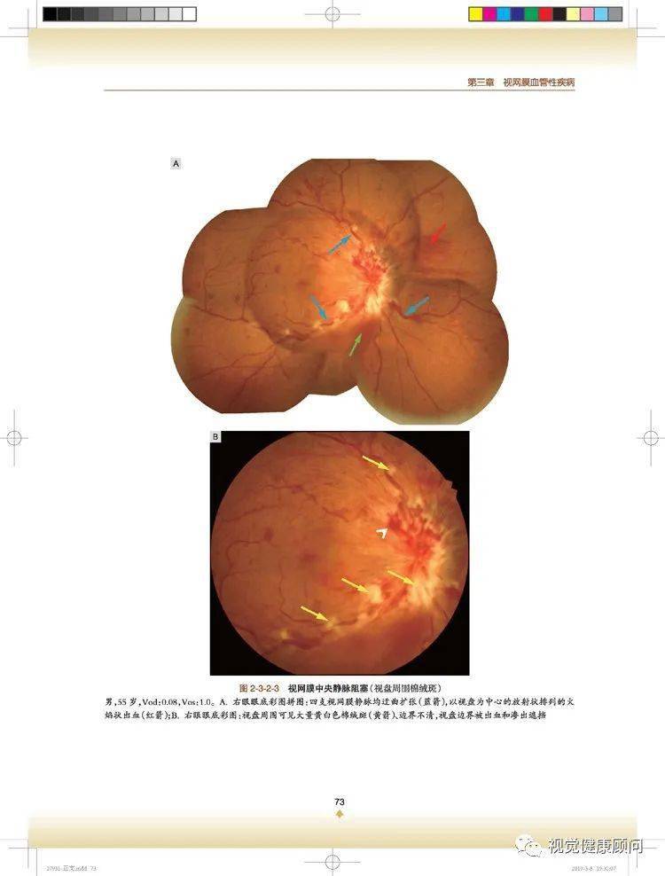 《眼底照相技巧与彩图解读》和《实用眼底相机临床拍摄技术》_视网膜
