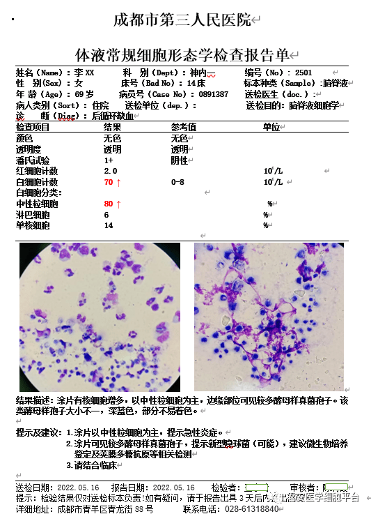 体液标本细胞学制片大赛获奖作品展示(脑脊液篇)_形态_案例_检查