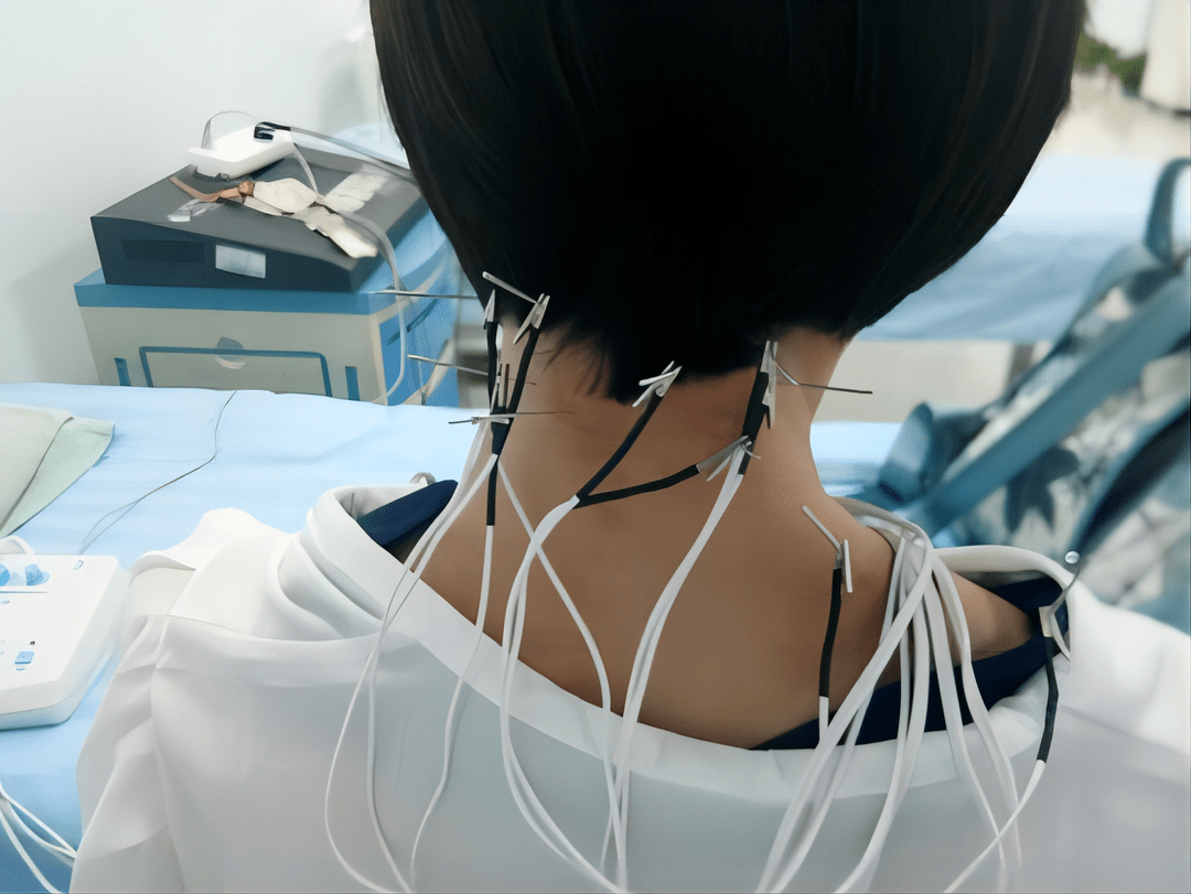 【医文医话】针灸治疗痛症之偏头痛_患者_疾病_疗法