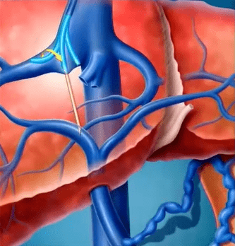 bd liverty64穿刺套件可调弯硬质套管和18g空心针设计提高穿刺效率.