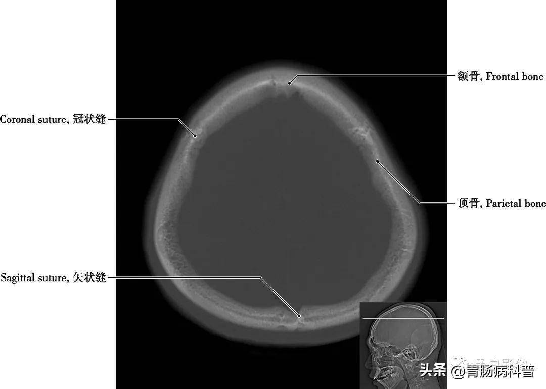 详细标注版——颅脑ct正常解剖图谱