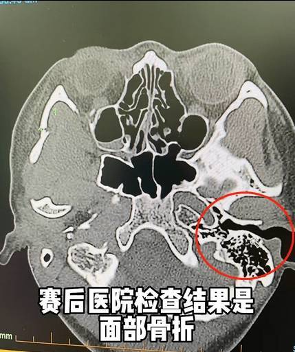 女足国脚：受伤的处所会成为最强壮的处所