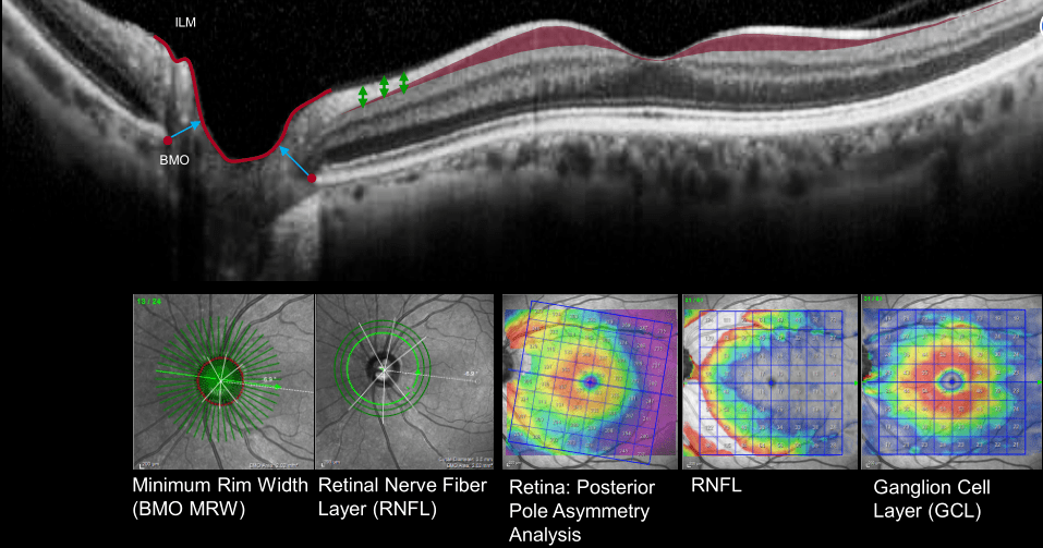 视网膜脱离oct报告图图片