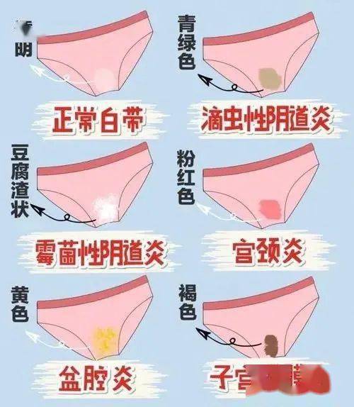 女性外阴囊肿的症状图片