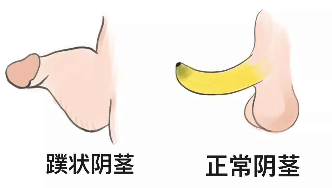 新野县人民医院男科开展了第一例蹼状阴茎和阴茎阴囊转位