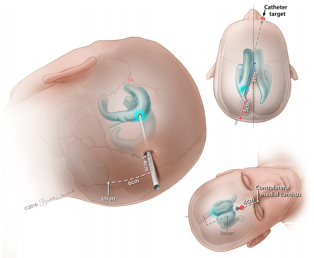 【精品内容】脑室穿刺九法_cm_额角_paines