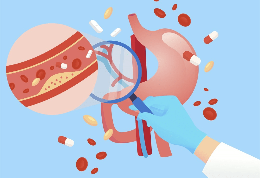 百姓健康 | 好习惯养出"年轻"血管_斑块_医生_干预