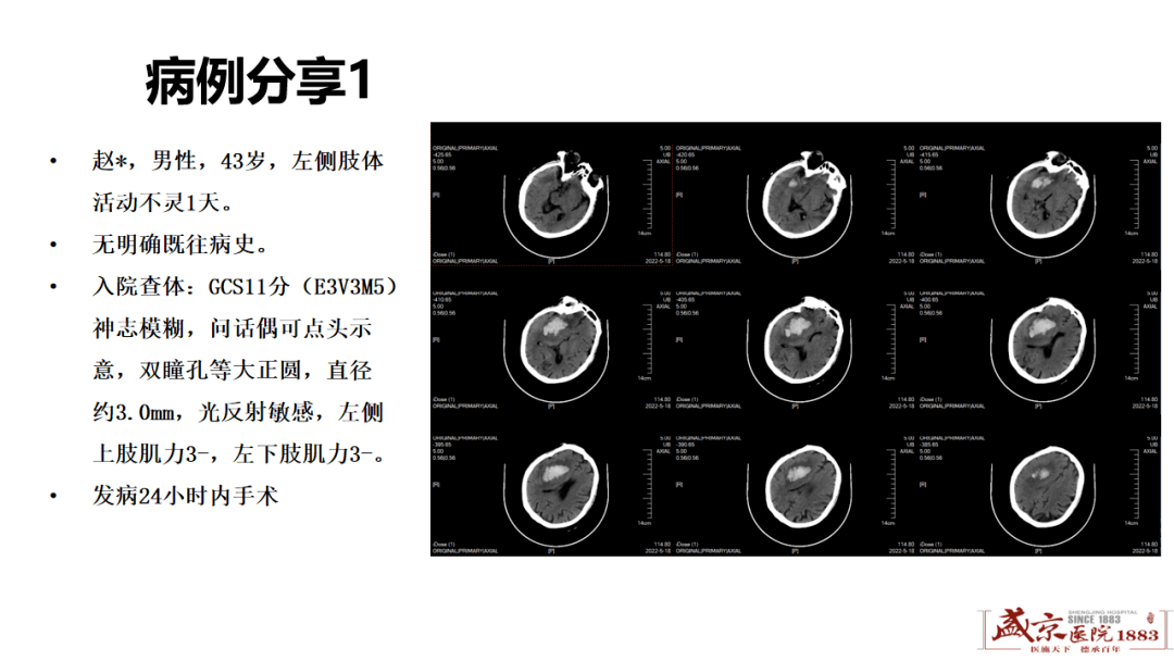 脑出血ct报告单图片图片