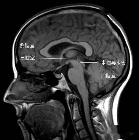 冠状位矢状位三脑室在哪